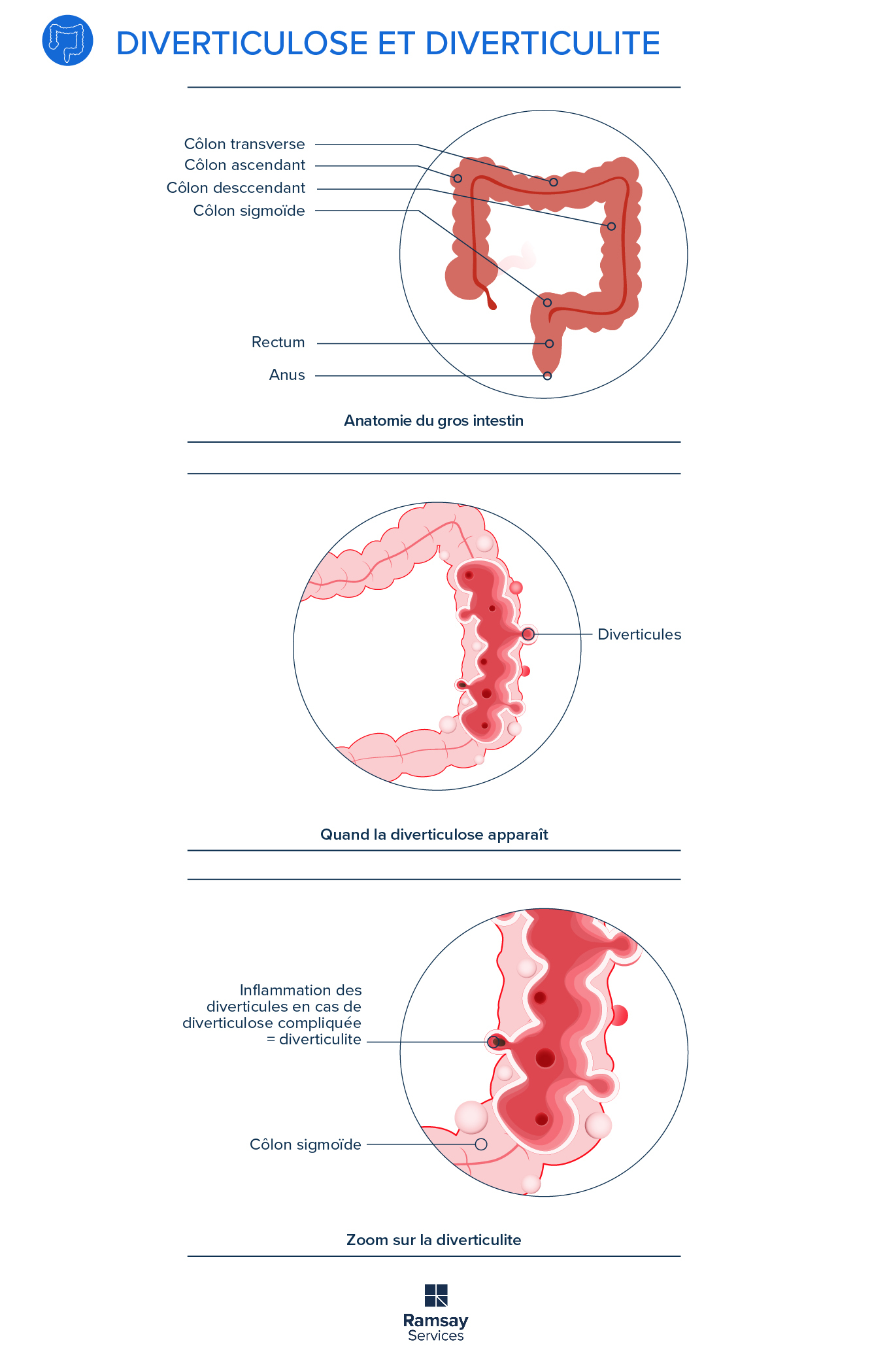 Diverticulose, diverticulite tout savoir sur ces pathologies du côlon